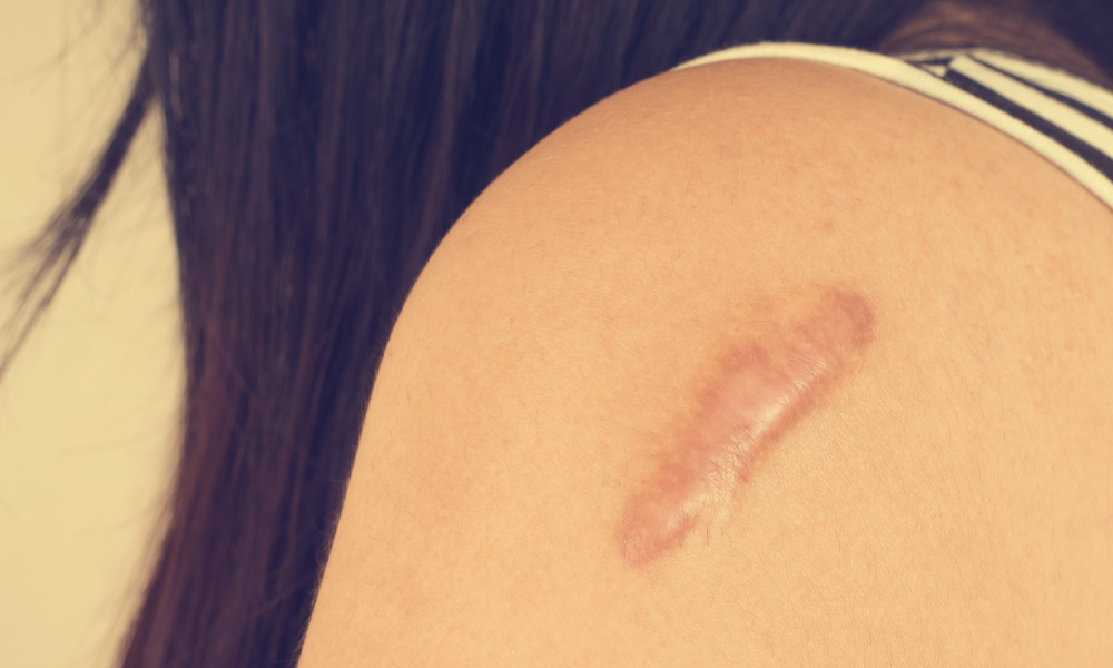 Burn scars – how to eliminate them effectively?