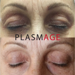 Noticeable effects of eyelid correction using PLASMAGE - Dr Parda Aesthetic Medicine Clinic