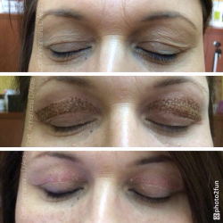 Plasma technology, upper eyelid lift - presentation of differences noticeable after the procedure - Dr Parda Aesthetic Medicine Clinic